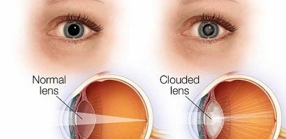MICS Micro Incision Cataract Surgery