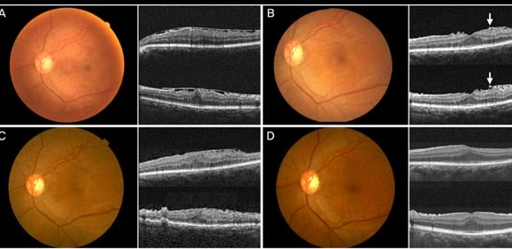 All Retina Investigations OCT And FFA