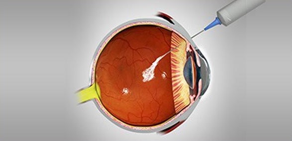 Intravitreal Anti VEGF Injections