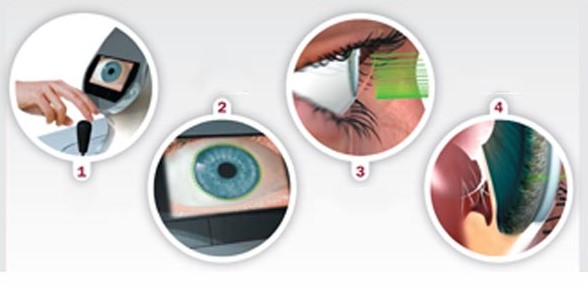 Glaucoma Complete Investigations
