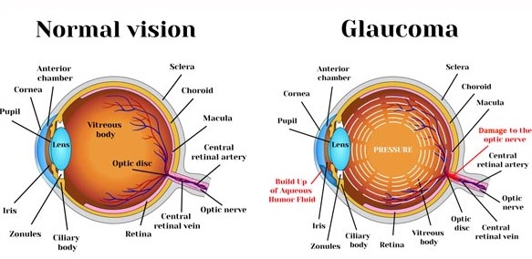 Glaucoma Diagnosis And Treatment