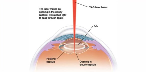 Nd Yag Laser PI & Capsulotomy