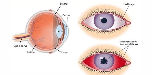 Uveitis Investigations And Management