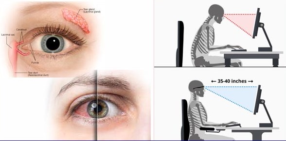 Ocular Surface Disorders & Dry Eye Management