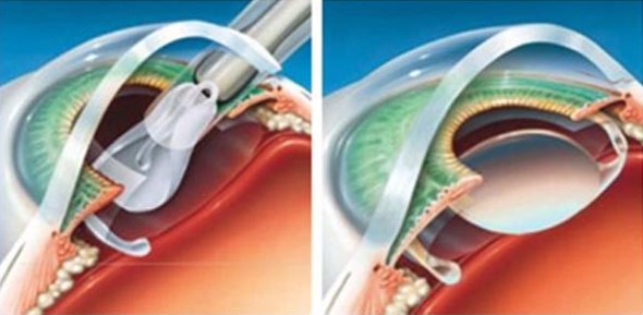 Phaco With Foldable Lens Implantation