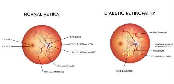 Diabetic Retinopathy Screening