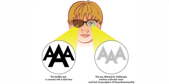 Amblyopia Evaluation And Therapy