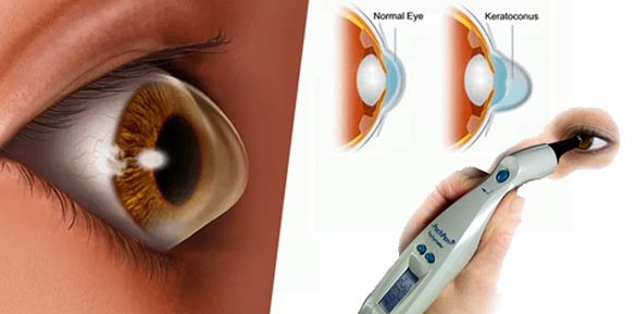 Keratoconus Investigations