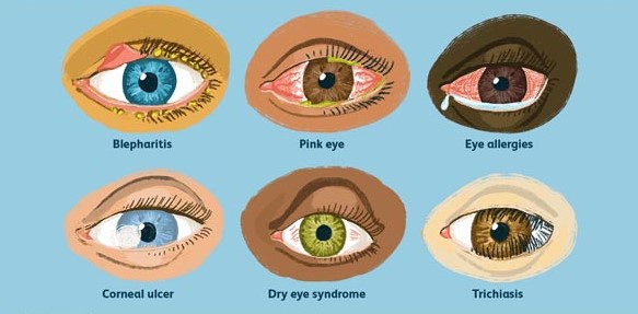 Eye Allergy Treatment