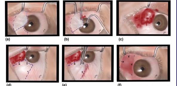 Pterygium Surgery