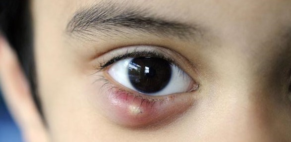 Chalazion Surgery