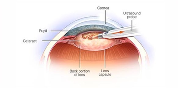Cataract Surgery Truly As Refractive Surgery